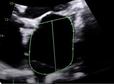 <p>Correctly measure LA area and length in A4C</p>