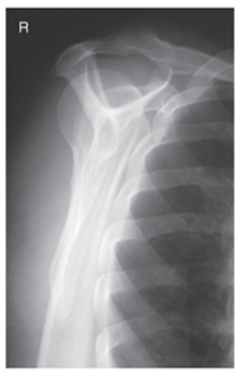 <p>- CR 10° to 15° caudad</p><p>- Supraspinatus outlet open and in profile</p><p>- Demonstrates coracoacromial arch</p><p>- Optimal exposure factors</p>