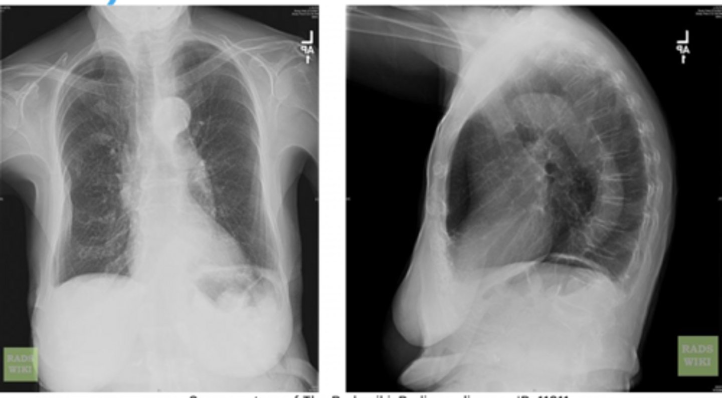 <p>Patient presents with dyspnea upon exertion, wheezing, productive cough, pursed-lip breathing, use of accessory respiratory muscles</p>