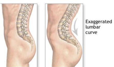 <p><strong>Lordosis</strong> = increased <strong>inward/forward</strong> curvature of the spine in the <strong>sagittal plane</strong>.<br>Common description: exaggerated <strong>lumbar curve</strong> or “swayback.”</p>