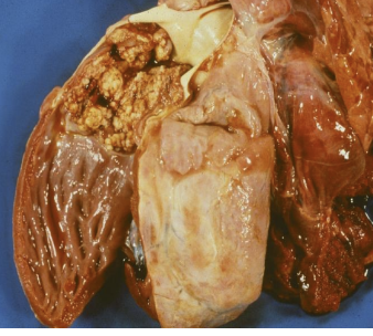 <p>Peracute septicemia; Acute meningitis; Chronic arthritis; Valvular endocarditis.</p>