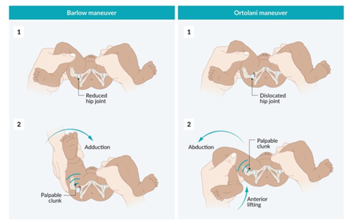 <p>Ortolani maneuver – The thigh is grasped loosely with the examiner's index and middle finger along the greater trochanter and the thumb on the inner thigh. From an adducted position, the hip is gently abducted with supination of the examiner's hand while lifting the greater trochanter anteriorly. Extreme abduction should be avoided because it decreases the sensitivity of the Ortolani maneuver. If the hip is dislocated, the Ortolani maneuver may reduce it and is accompanied by a palpable clunk. A positive Ortolani maneuver assumes a dislocated hip that is reducible.</p><p>●Barlow maneuver – The hip is held in the same manner as for the Ortolani maneuver. The thigh is grasped loosely with the examiner's index and middle finger along the greater trochanter and the thumb on the inner thigh. The hip is gently adducted with pronation of the examiner's hand and, in a change from previous recommendations, no downward pressure is applied. The femoral head is palpated to detect moving out of the back of the acetabulum. The examiner should not attempt to forcefully dislocate the femoral head [5]. If the hip is dislocatable, posterior movement and a palpable clunk may be detected as the femoral head exits the acetabulum (the "jerk of exit") [5,26,37,38]. A subluxatable hip is characterized by a subtle sliding movement or a feeling of looseness, like a tennis ball moving in a soup bowl. A positive Barlow maneuver assumes a reduced hip that is subluxatable or dislocatable [5].</p><p>The "jerking" and/or "clunking" sensation of hip reduction and dislocation is distinct and different from the signs (eg, snapping, clicking, high pitch joint popping) of benign tendon or ligament snapping in and around the hip and knee. The term "hip click" is misleading and is best avoided; isolated hip clicks are not suggestive of DDH [39-41].</p>