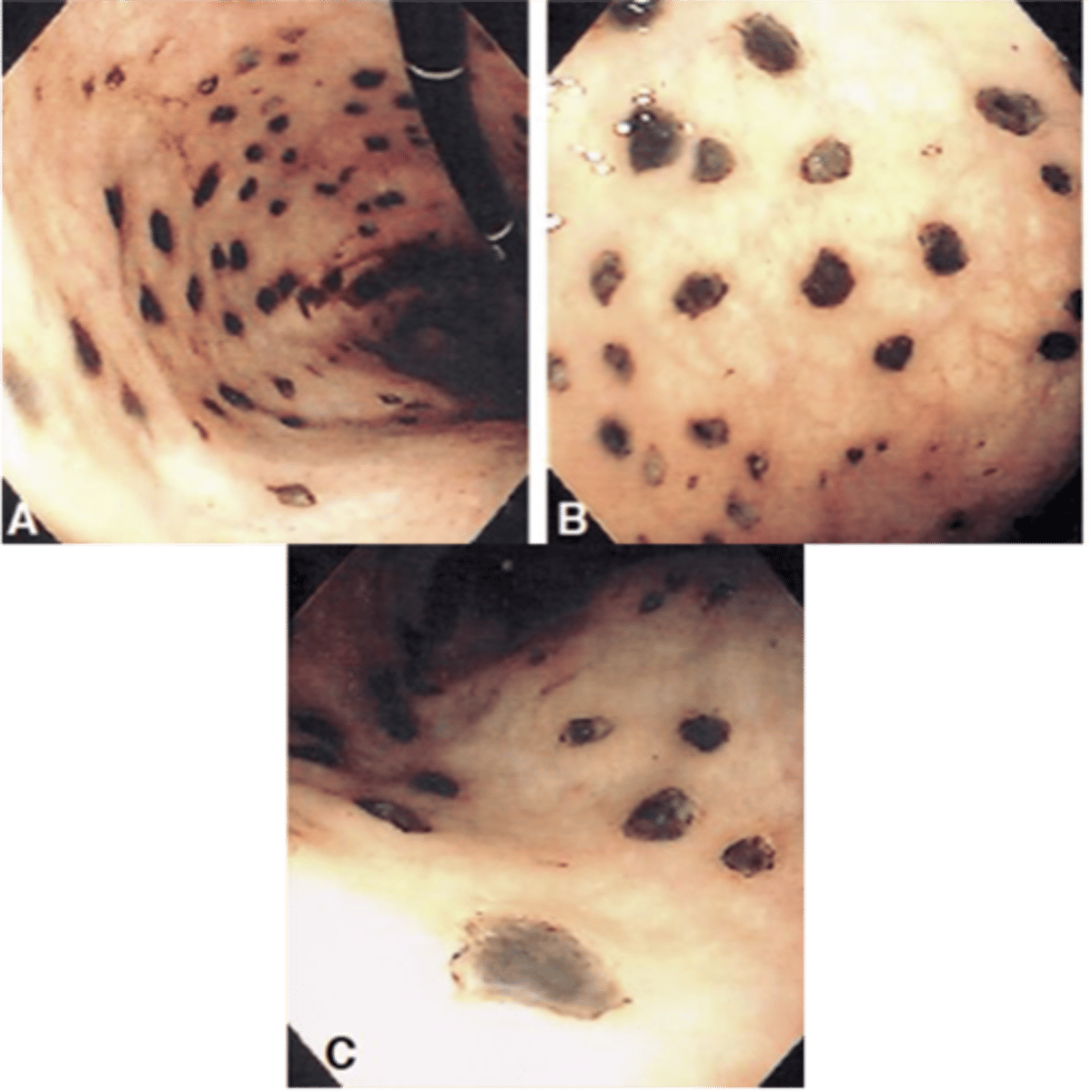 <p>Define Condition:</p><p>Shallow erosions caused by superficial epithelial damage, or deeper lesions that penetrate the depth of the mucosa​</p><p>-Hx: Hospitalized Pts</p><p>&gt; Severe Trauma</p><p>&gt; Shock</p><p>&gt; Sepsis</p><p>-Path:</p><p>&gt; Healing with complete re-epithelialization occurs days or weeks after the inciting factors are removed without scarring​</p><p>&gt; D/t LOCAL ISCHEMIA</p><p>&gt; ANYWHERE in stomach (often multiple)</p><p>-Sx:</p><p>&gt; Asx</p><p>&gt; Gnawing/Burning Epigastric distress</p><p>&gt; N/V</p><p>-PE:</p><p>&gt; Hematemesis</p><p>&gt; Melena</p><p>-Dx:</p><p>&gt; Endoscopy: STRESS ULCERS (Multiple dark brown, shallow erosions)</p><p>&gt;&gt; Curling Ulcers (BURNS/trauma --&gt; Hypovolemia --&gt; Ischemia in Proximal Duodenum)</p><p>&gt;&gt; Cushing Ulcers (BRAIN Injury --&gt; High ICP --&gt; Vagal Stimulation = ACH ==&gt; H+ Production --&gt; Seen in Stomach, Esophagus or Duodenum)</p><p>-Tx:</p><p>&gt; Prophyl = PPIs</p><p>&gt; Tx Underlying Illness</p>
