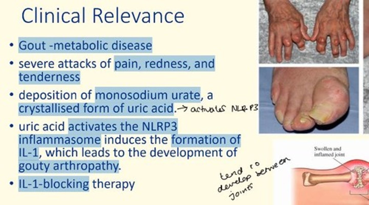 <p>Gout metabolic disease</p><p>Deposition of monosodium urate (crystallized form of uric acid) which activates the NLR-P3 inflammasome. This induces formation of IL-1. </p><p>The IL-1 secretion leads to formation of gouty arthropathy. </p><p>IL-1 blocking therapy can therefore be given as a treatment for Gout.</p>