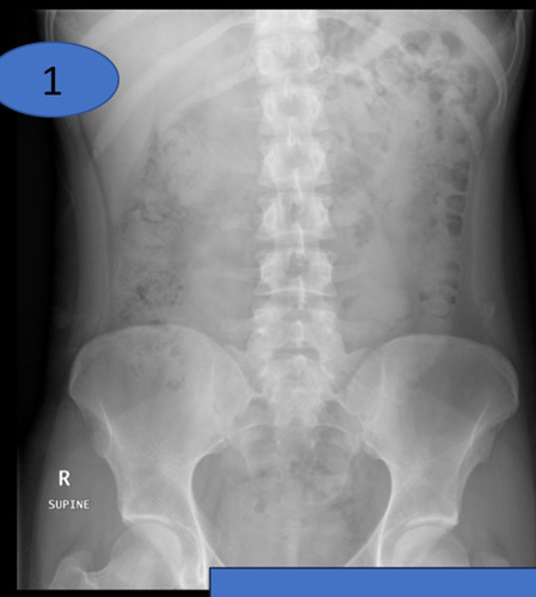 <p>kidnets, ureters, bladder view; assessment of bowel and urogenital system; VERY SIMILAR TO AP supine</p><p>does not necessarily contain diaphragms</p>