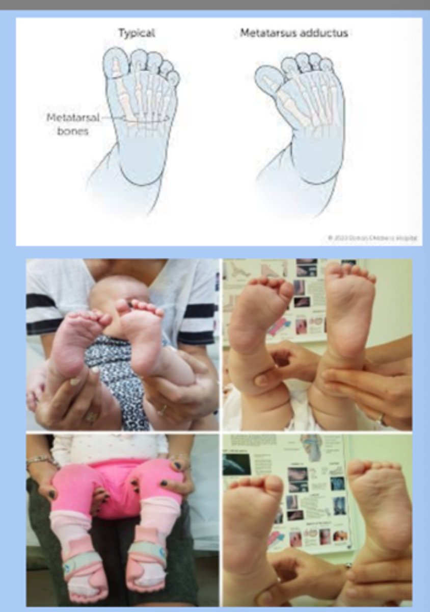 <p>-most common foot deformity </p><p>-inward forefoot deviation </p><p>-flexible: resolves spontaneously</p><p>-rigid: vertical creases, needs tx </p><p>-10% have hip dysplasia </p>