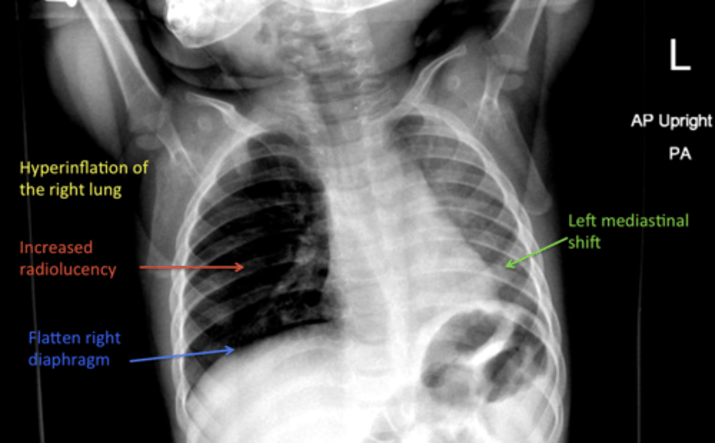 <p>a check valve effect</p><p>- airways dilate during inhalation, permitting air to pass by a partial obstruction; however, airways constrict tightly around the obstruction during exhalation resulting in trapped air/hyperinflation</p>