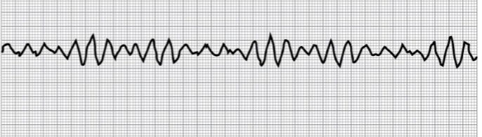 <p>Rate: None<br>Rhythm: Irregular<br>P-Wave: None<br>PR: None<br>QRS: Ventricular Chaos</p>
