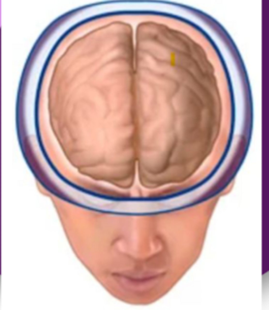 <p>- Everywhere</p><p>- Gradual onset, lasts 30 mins to 7 days.</p><p>- Pain: band-like tightness and non-throbbing</p><p>- Cause: stress, anxiety, depression, poor posture, poor sleep, screen time</p><p>- Tx: NSAIDs, stress reduction, and non-pharm</p>