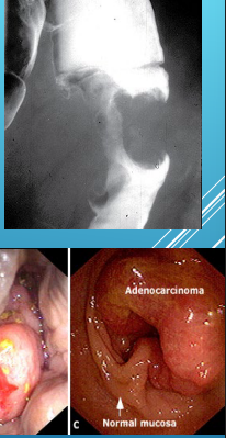 <p><strong>Colorectal Cancer: Diagnosis</strong></p><p>-Colonoscopy (preferred)</p><ul><li><p>Endoluminal mass arising from ______</p></li><li><p>Bleeding may be present</p></li><li><p>______ must be done to confirm diagnosis </p></li></ul><p>-Barium Enema</p><ul><li><p>_____ ____ lesion</p></li></ul><p>-CT colonography </p><p></p>