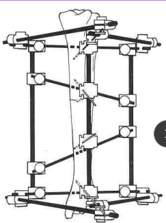 <p>Linear type 3 ESF</p>