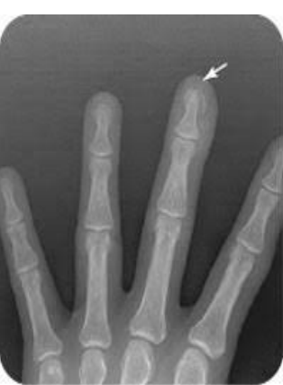 <p>What type of fracture is shown here?</p>