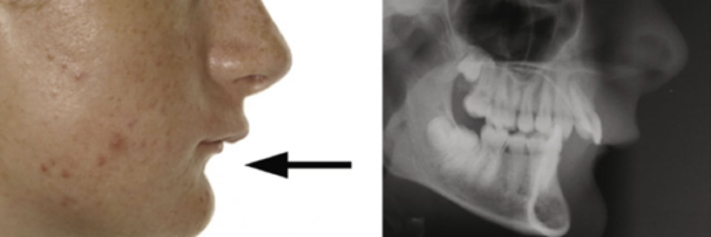 <p>retroclination of lower incisors</p>
