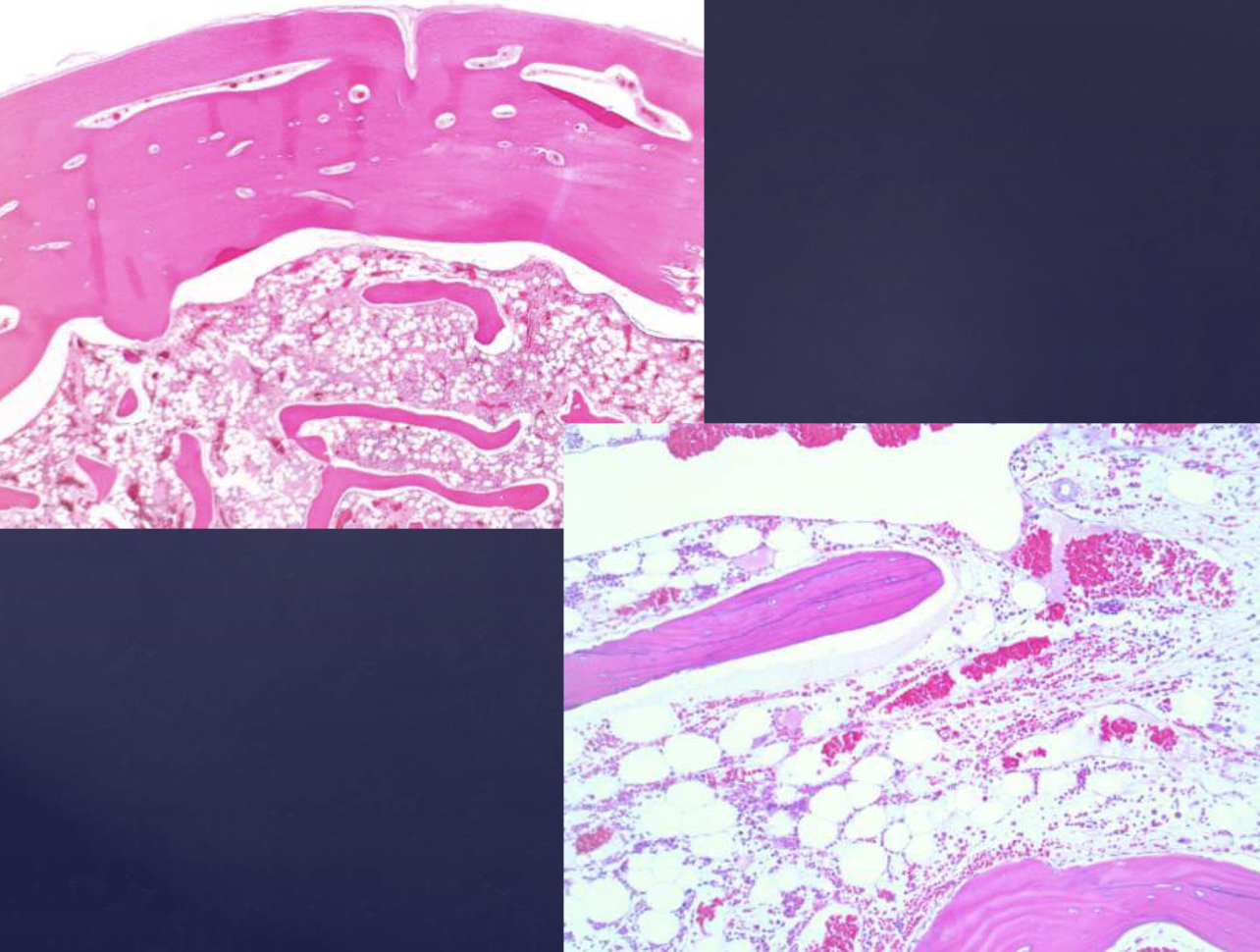 <p>compact lamellar bone w/ fibrofatty marrow, similar to tori + exostoses </p>