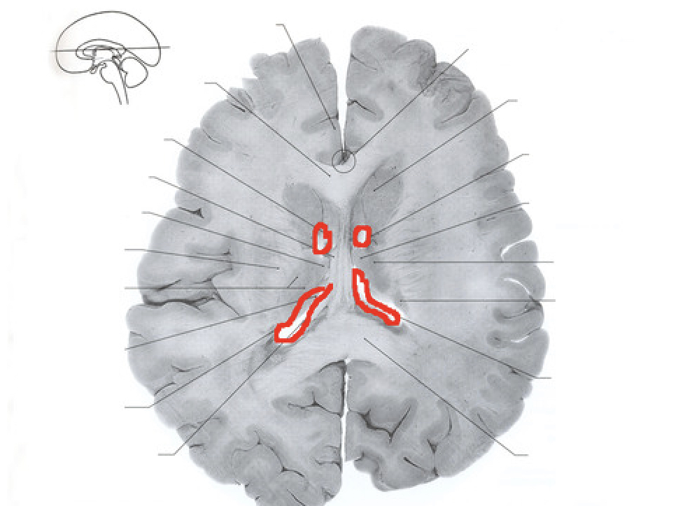 <p>either of two horseshoe-shaped ventricles one in each cerebral hemisphere; they communicate with the third ventricle via the foramen of Monro</p>