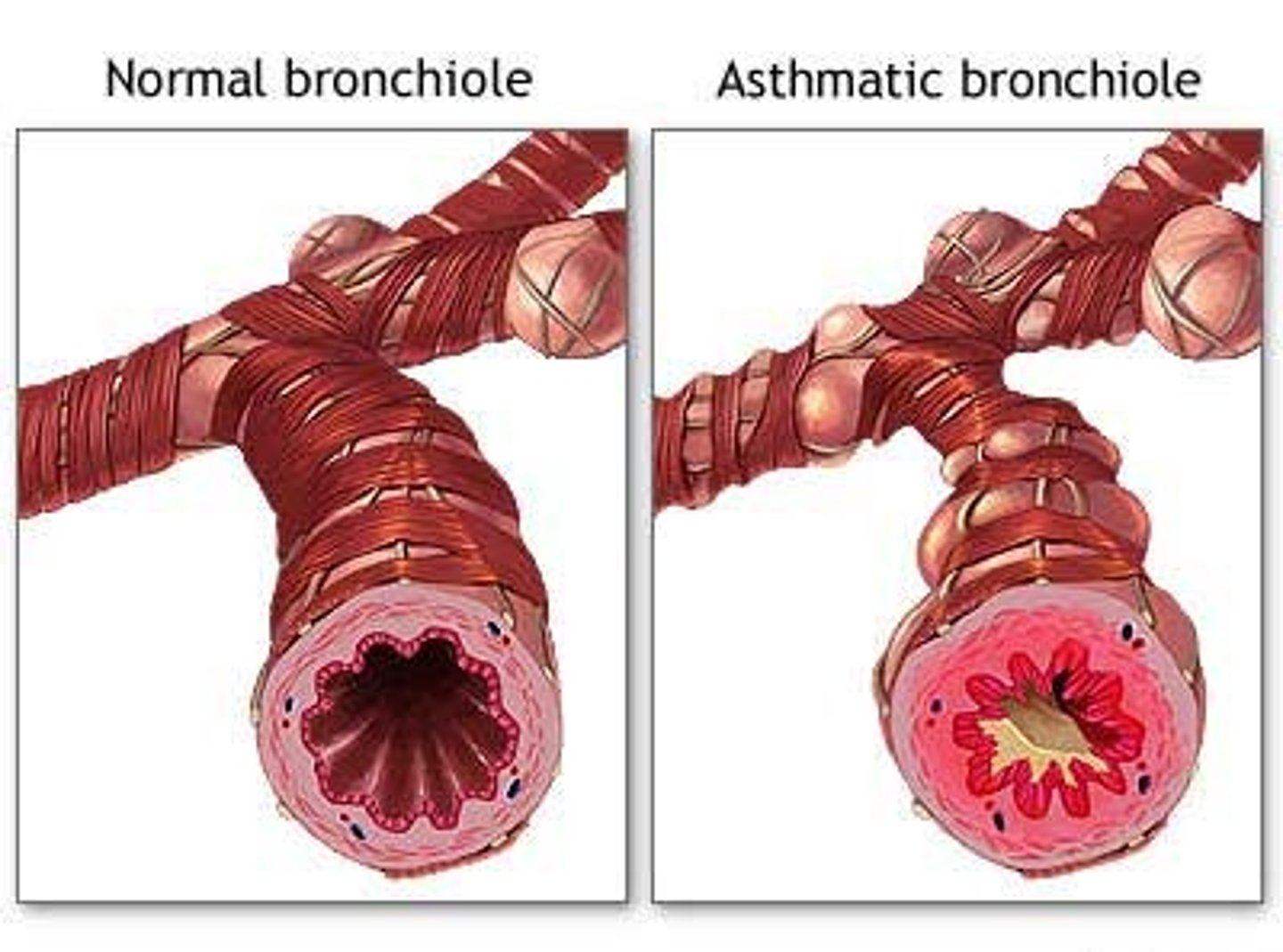 <p>reduction in diameter of a bronchus</p>