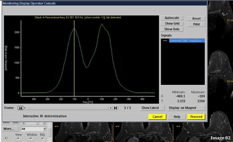 <p><strong>Aside from the center frequency, what other indicator in Image 82 signifies it was acquired at 1.5 Tesla?</strong></p>