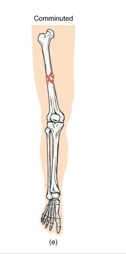 <p><strong>Definition: Bone is shattered into three or more fragments.</strong></p><p><strong>Mechanism: high impact trauma</strong> (ex: car accidents, falls from height)</p><p><strong>Clinical note:</strong> Complex repair; may require surgical plates/pins; slow healing.</p><p><strong>Key concept: represents severe energy transfer </strong>→ bone fragmentation</p>