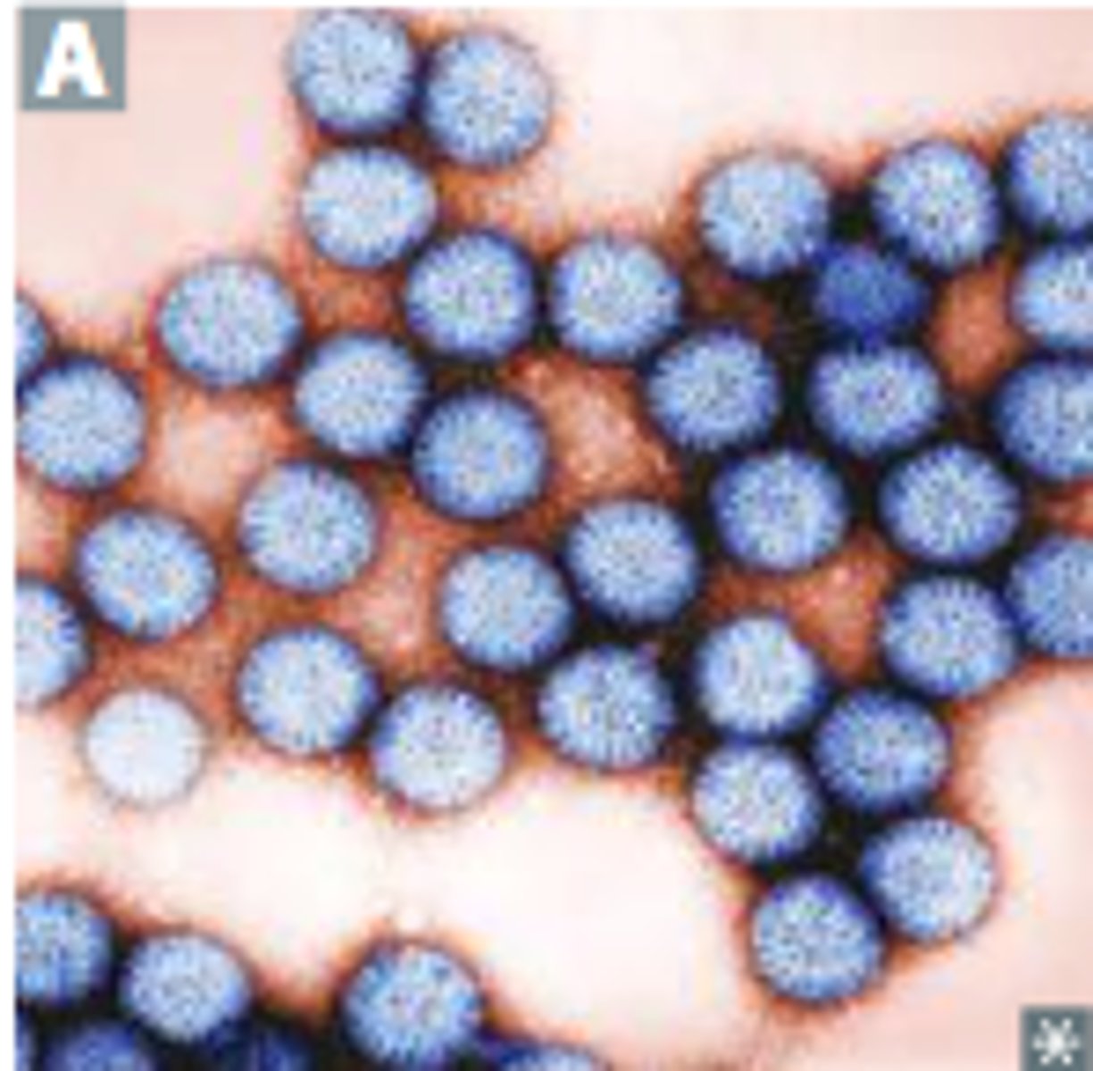 <p>Identify Pathogen causing Diarrhea:</p><p>Non-enveloped dsRNA virus</p><p>&gt; MCC of Watery Diarrhea in Unvaccinated children &lt; 5 y/o</p><p>-Hx:</p><p>&gt; Fecal-Oral Transmission (Daycare Centers)</p><p>-Path: Virus destroys the absorptive capacity of villi -&gt; incompletely absorbed nutrients osmotically active -&gt; water secreted into GI tract -&gt;</p><p>-Sx/PE:</p><p>&gt; Watery Diarrhea</p><p>-Dx:</p><p>&gt; Virus found in Stool</p><p>&gt; (-) Fecal Smear</p><p>-Tx:</p><p>&gt; Vaccine to prevent in children &lt; 6 mo</p>