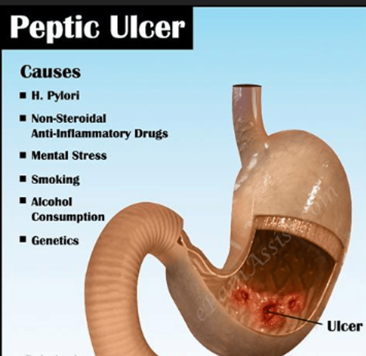 <p>D</p><p>Peptic ulcer disease occurs with the frequent use of nonsteroidal antiinflammatory drugs, alcohol use, smoking, and Helicobacter pylori infection.</p>