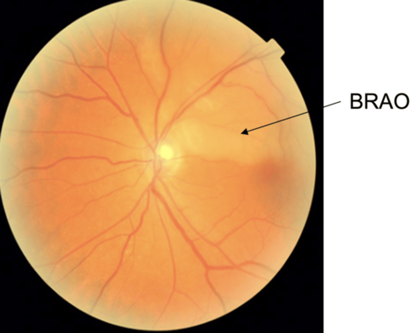 <p>1. cholesterol</p><p>2. calcium</p><p>3. crystals of a drug (iv drug use/abuse)</p>