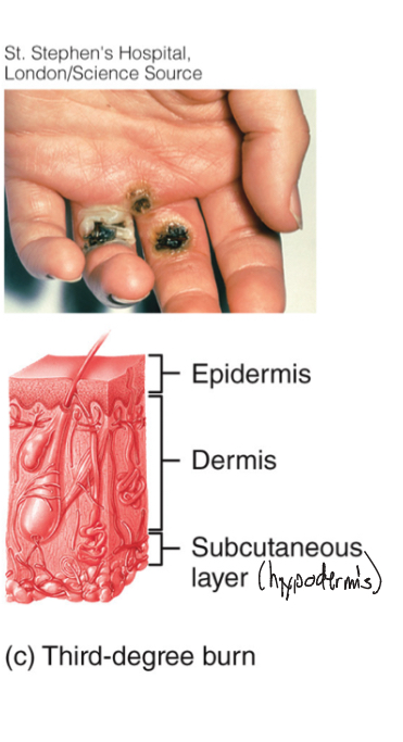 <p>-all 3 layers</p><p>-most skin functions lost, marked swelling, numbness, skin cant heal</p>