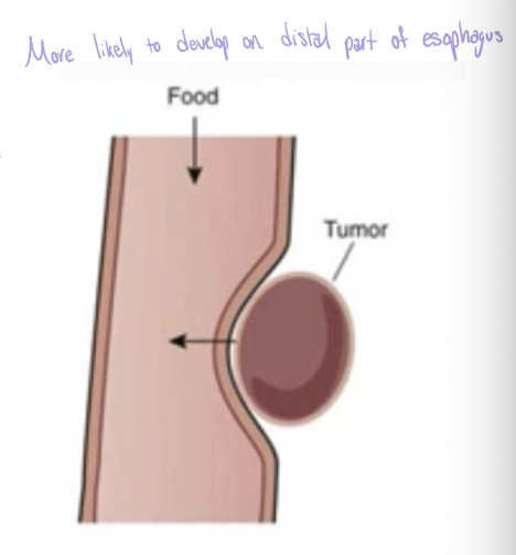 <ul><li><p>Primarily squamous cell carcinoma (most common distal esophagus)</p></li><li><p>Significant dysphagia in later stages</p></li><li><p>Poor prognosis due to late manifestation</p></li><li><p>Associated with chronic irritation due to: Chronic esophagitis, Achalasia, Hiatal hernia, Alcohol abuse and smoking</p></li></ul><p></p>