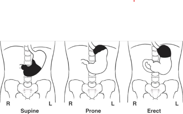 <ul><li><p>Supine - Fundus</p></li><li><p>RAO - Body and Pylorus</p></li><li><p>Prone - Body and Pylorus</p></li><li><p>Erect - Body and Pylorus</p></li></ul><p></p>