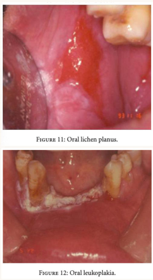 <p>what nutrient deficiencies are related with these oral lesions?</p>