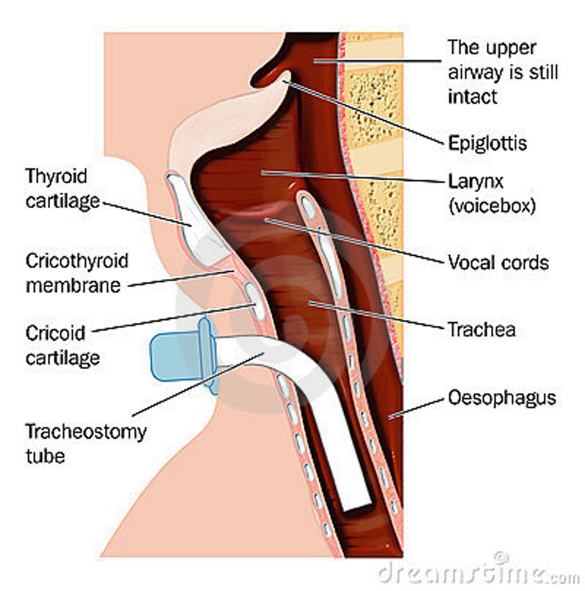 <p>creation of an artificial opening into the trachea</p>