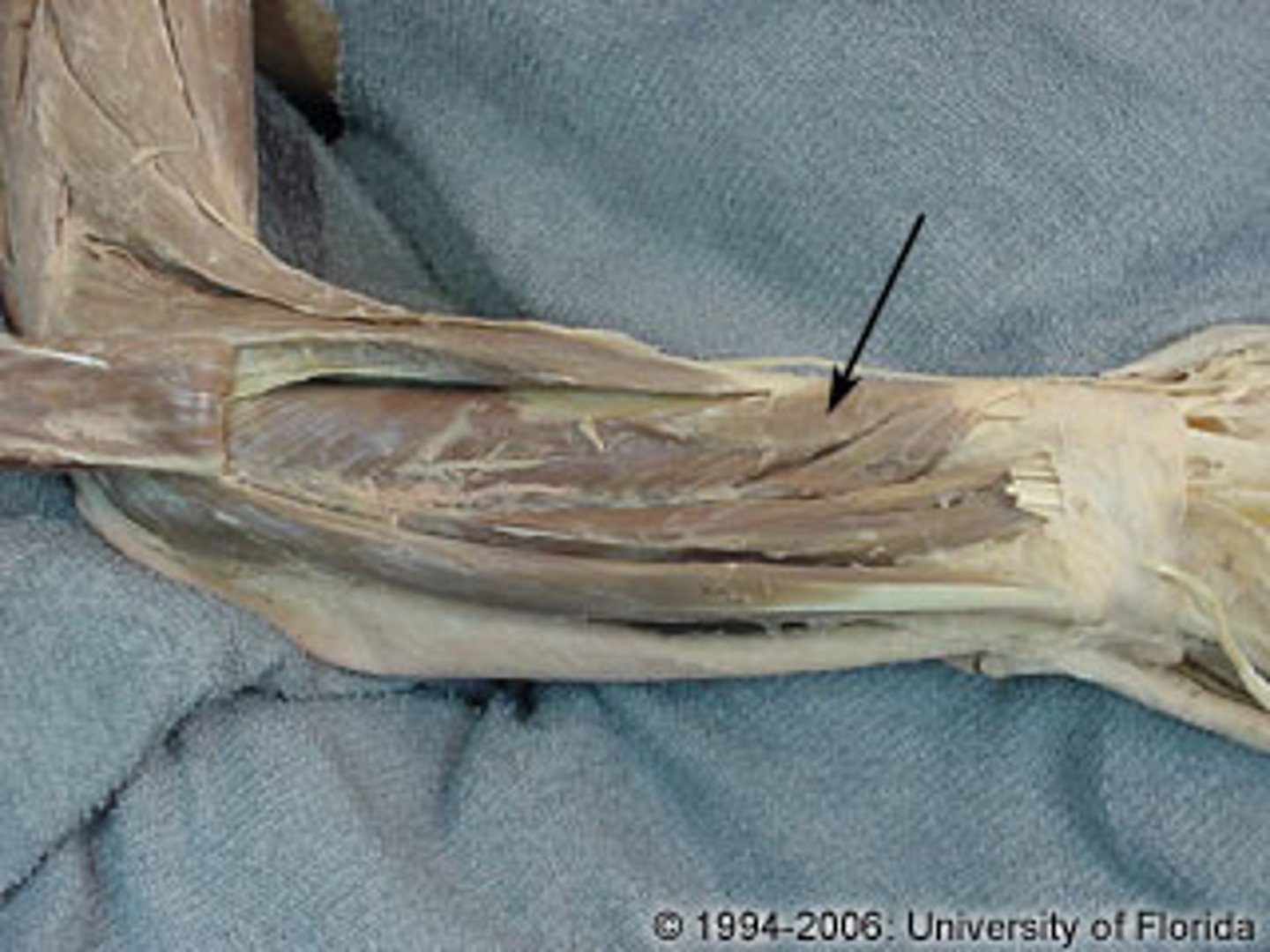 <p>What muscle is this?</p><p>Origin?</p><p>Insertion?</p><p>Action?</p><p>Nerve?</p>