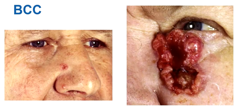 <p>Moeilijkste variant van BCC’s</p><ul><li><p>Er is littekenvorming.</p></li><li><p>Het groeit in sprietjes (in tegen stelling met nodulaire, die in rondjes groeit) waarbij littekenvorming en fibrose plaatsvindt.</p></li><li><p>Hier zie je geen glimmende rand. Wel zie je teleangiëctase.</p></li><li><p>Typisch voor deze variant is dat de rand groter is dan je denkt. Vaak wordt een grote stuk dan weggehaald.</p></li><li><p>Moeilijkste variant en hoogste risico. Moet echt behandeld worden want anders groeit het zo</p></li><li><p>Sprieterig, maar kan ook micronodulair zijn</p></li></ul><p></p>