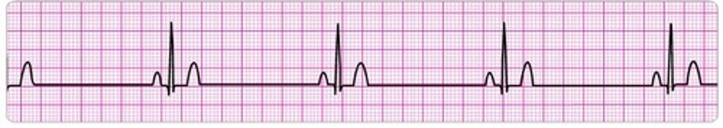 <p>sinus rhythm but the heart rate is below 60bpm. may be normal for athletes or during sleep, seen with inferior and posterior infarctions</p>