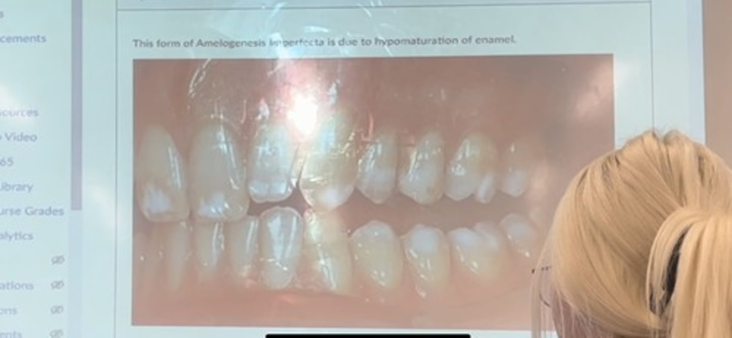<p>This form of amelogenesis imperfecta is due to hypomaturation of enamel</p>