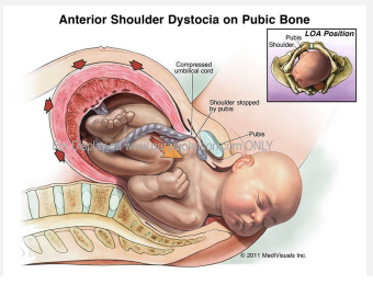 <p><strong>Management of Shoulder Dystocia</strong></p><p>-Must anticipate it&nbsp;</p><ul><li><p>Practice via _____, call for help, remain calm, take charge&nbsp;</p></li><li><p>Highly anticipate for the patients who have estimated _____g babies (without DM) or 4500g (with DM)</p></li></ul><p>-Deliver within _____ minutes&nbsp;</p><p>-Call for ____</p><p>-Try gentle ________ first&nbsp;</p><ul><li><p>Apply pressure on the fetal vertex in a _______ direction helps move the anterior shoulder&nbsp;</p></li><li><p>Done before anyone suspects shoulder dystocia&nbsp;</p></li></ul><p></p>