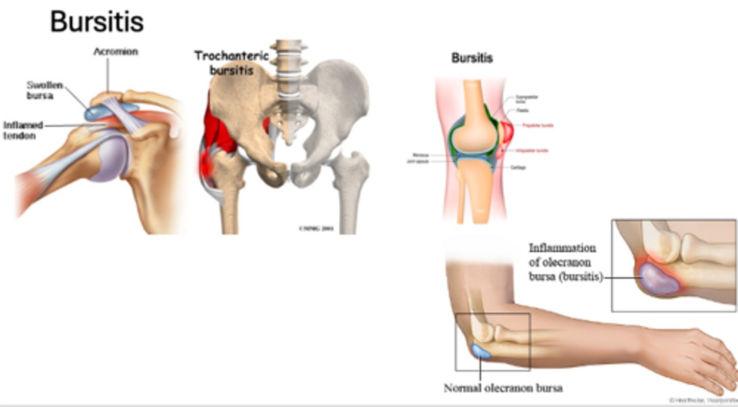 <p>- Subacromial bursitis (shoulder)</p><p>- Olecranon bursitis (elbow)</p><p>- Trochanteric Bursitis (hip)</p><p>- Prepatellar Bursitis (knee)</p>