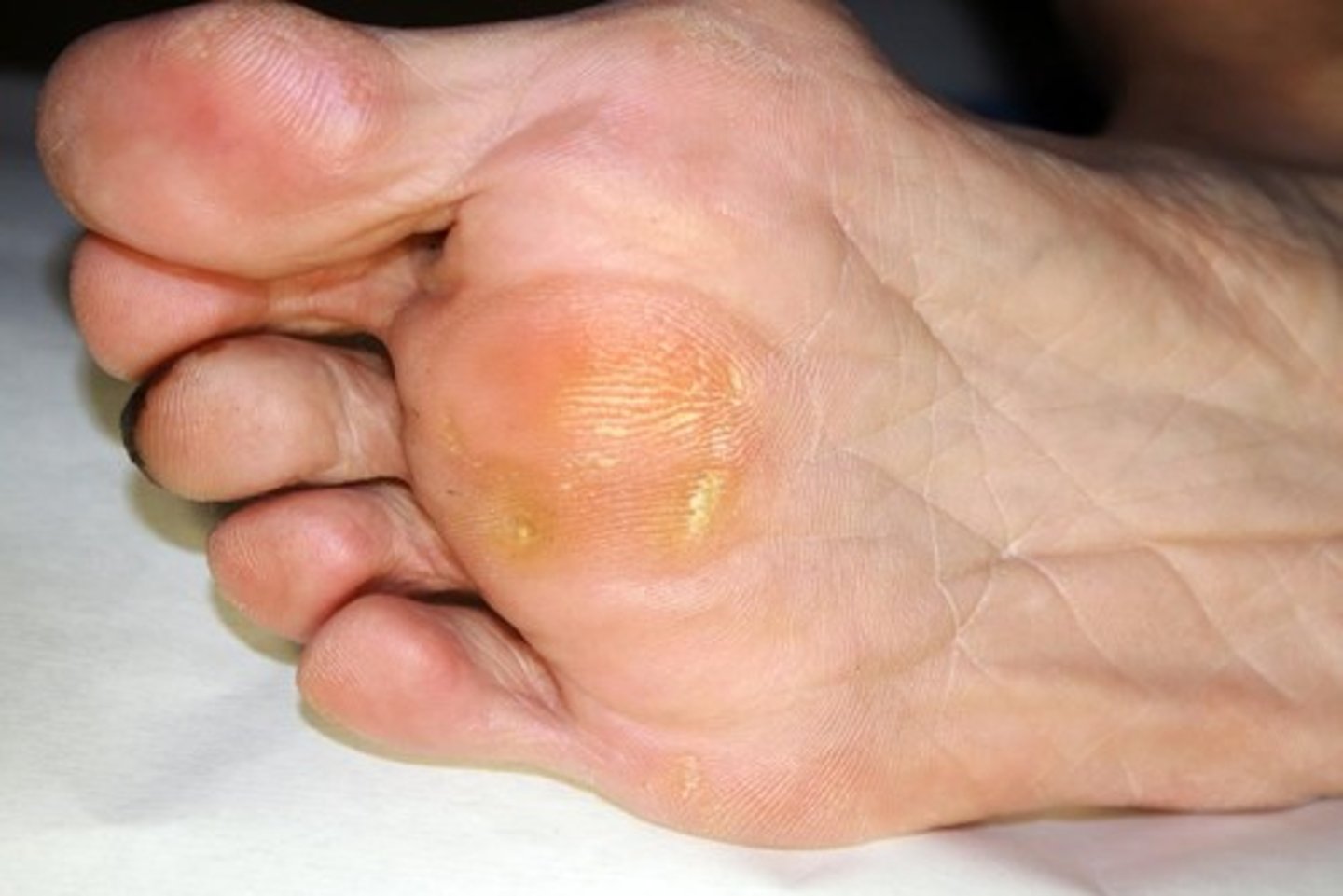 <p>an acquired, thickened patch of epidermis. a callus caused by pressure or friction</p>