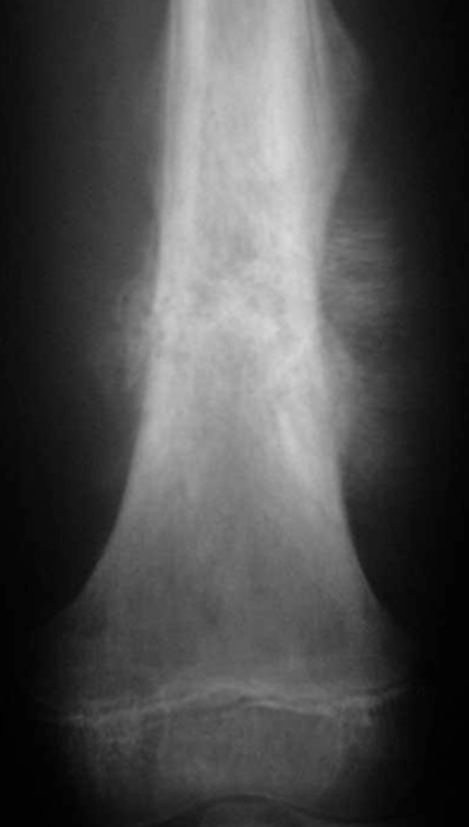 <p>Osteosarcoma usually occurs in 15-25-year-old males and is most commonly found around the knee</p>