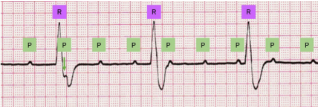 <p><u>In Complete Heart Block</u></p><ul><li><p>__ to vessels suppling AV node</p></li><li><p>electrical __ between SA/AV nodes and His-Purkinje-ventricles</p></li><li><p>_ waves and __ are unrelated, QRS spike __, and notable T wave __</p></li></ul><p></p>