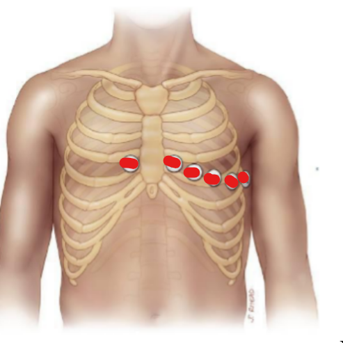 <p>V1 is (left/right-most)</p><p>V6 is (medial/lateral-most)</p>