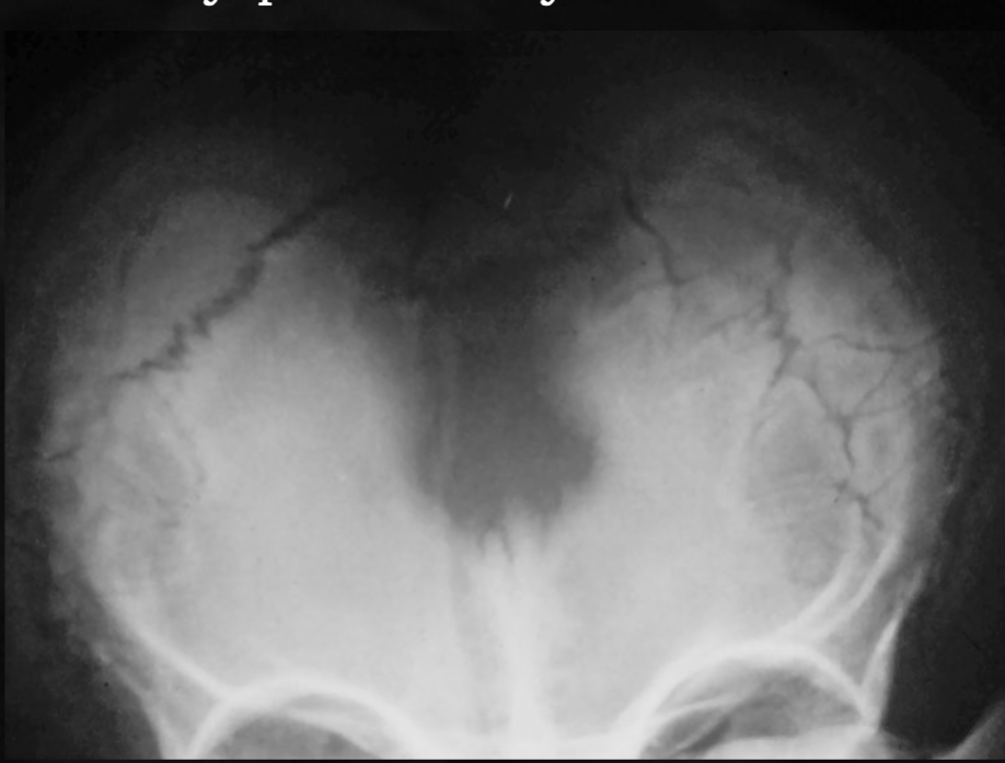 <p>what is seen here for this case of cleidocranial dysplasia?</p>