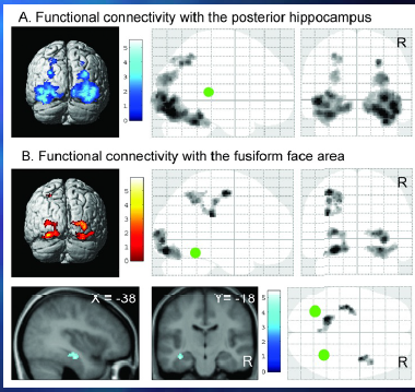 <p>functionele connectiviteit == modulatie is van activiteit tegelijkertijd in verschillende gebieden</p><p>Functional connectivity decreases:</p><p>hippocampus » early vis areas, FFA, PPC</p><p></p><p>Functional connectivity increases:</p><p>FFA » early vis areas, PPC / motor cortex</p>