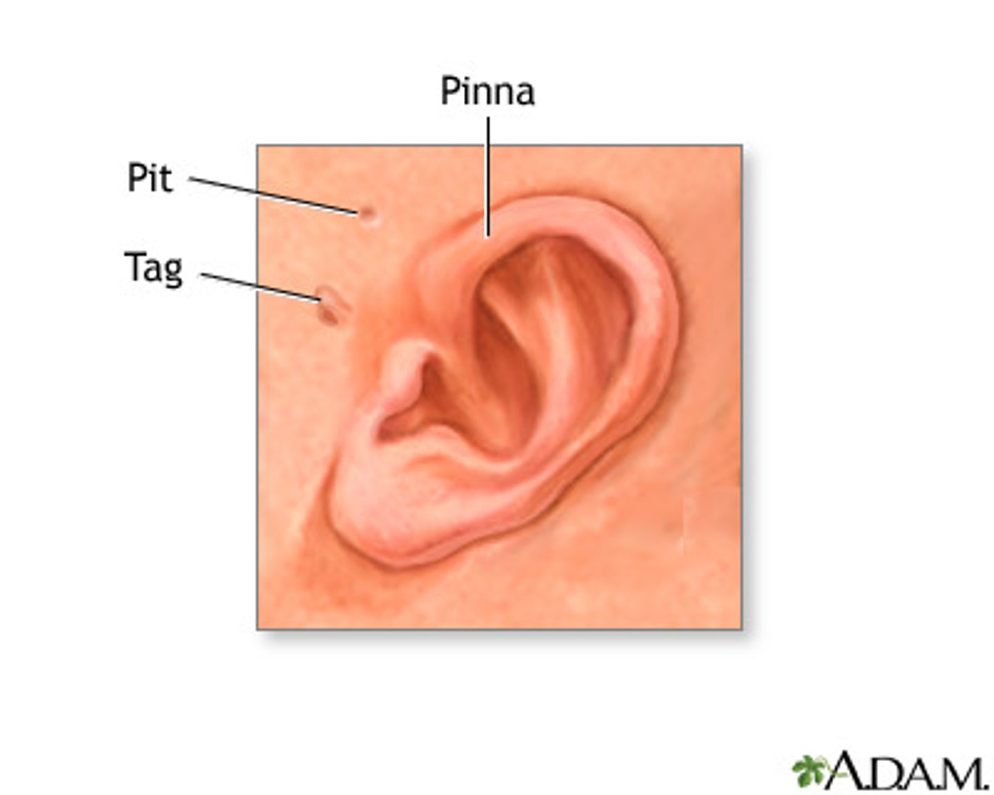 <p>A small indentation or outgrowth of skin in front of the ear.</p>