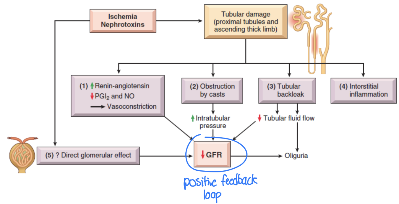 <ol><li><p>Ischemia → RAA activation → vasoconstriction of afferent arteriole</p></li><li><p>Damaged tubular epithelial cells are shed from BM and obstruct tubular flow</p></li></ol><ul><li><p>Increasing tubular pressure forces filtrate through tubular BM into interstitial space → tubular back leak</p></li></ul><p>3. Interstitial inflammation</p><p>Positive damaging feedback loop </p><p></p>