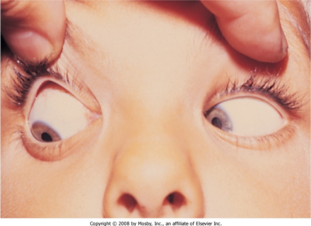 <p>moderate exotropia or slight deviation upward</p>