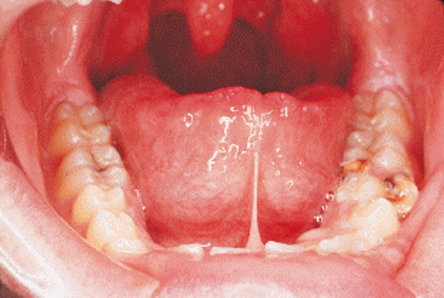 <p>Ankyloglossia</p><p>floor of the mouth caused by a short lingual frenum.</p><p>A frenectomy is a surgical procedure performed to remove a portion of the lingual frenum in the treatment of ankyloglossia. </p><p>Lingual thyroid is a smooth nodular mass at the base of the tongue posterior to the circumvallate papillae and near the midline. </p><p>Total ankyloglossia rarely occurs.</p>