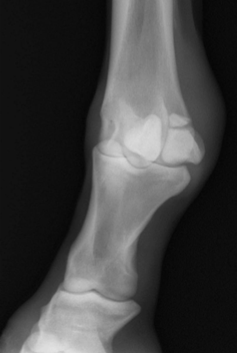 <p>What structure caused the avulsion?</p>