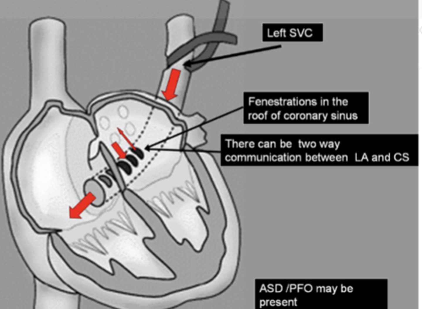 <p>persistent LSVC that drains through the coronary sinus</p>