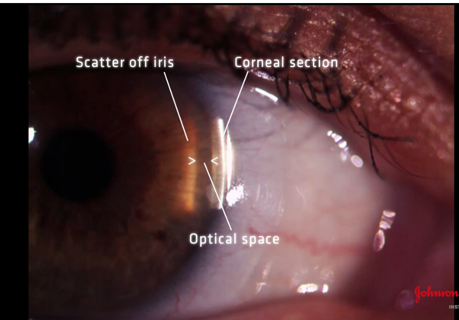<p>Ensure angle of observation and illumination is 60 degrees </p><p>Locking it in place </p><p>nose will get in way of illumination system </p><p>So move the observation and illumination System temporally about 5-10 degrees</p><p>Ask patient to look at observation system </p><p>Measure van hericks </p>