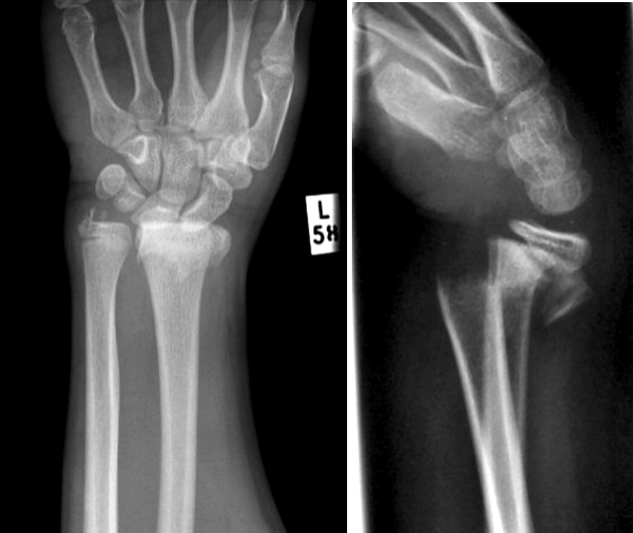 <p>fracture of distal radius w/ dorsal angulation of distal fragment; also includes fracture of ulnar styloid</p><p>MOI- falling on outstretched hand (FOOSH)</p>